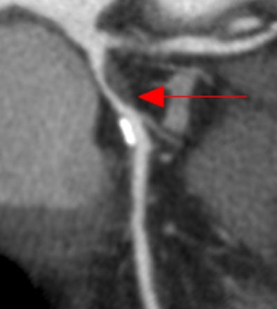 2009 11 16 13 09 51 892 Schoepf curvedmpr Smaller Size