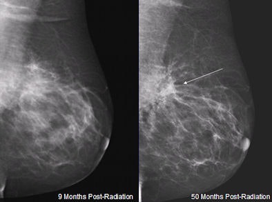 2009 12 02 12 52 05 760 Mammo Distortion 394