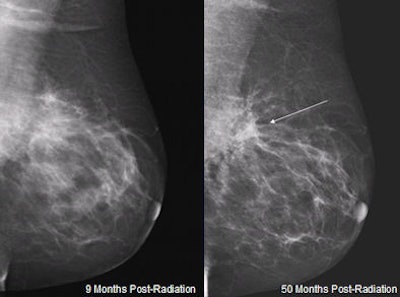 2009 12 02 12 52 05 760 Mammo Distortion 394