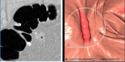 2009 12 15 13 33 30 509 Iafrate 6lesions top