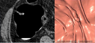 2009 12 15 13 33 34 968 Iafrate 6lesions bottom