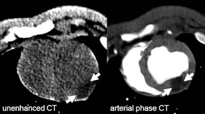 2009 12 16 11 45 46 326 Mahnken middle unenh arterial ct