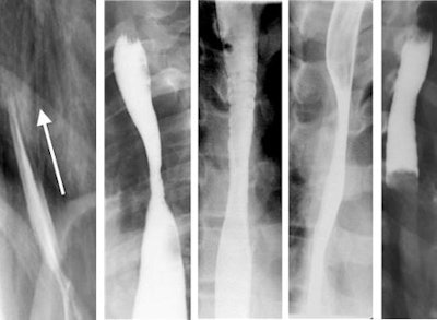 2009 12 23 13 34 20 217 Ped Esophagus 450