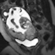 2010 01 05 12 13 28 973 Mr Placenta Accreta 01 Thumb