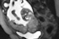 2010 01 05 12 13 28 973 Mr Placenta Accreta 01 Thumb
