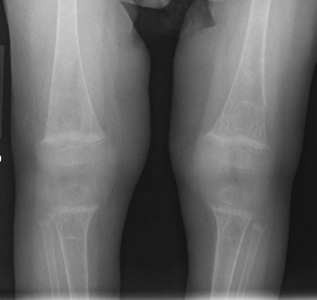 Infants With Rickets Bone fractures in infants with rickets differ from child-abuse injuries ...