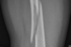 2010 01 15 13 00 12 952 Tc Fig1b Normal Bone Femur Fx Lateral Thumb