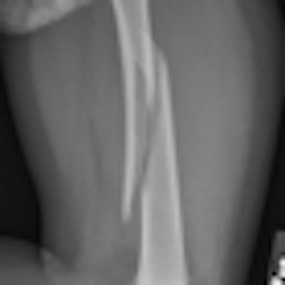 2010 01 15 13 00 12 952 Tc Fig1b Normal Bone Femur Fx Lateral Thumb