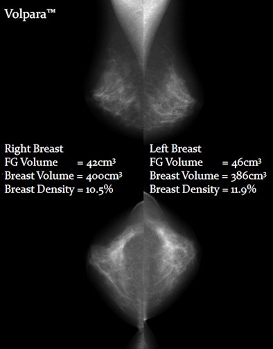 2010 01 29 11 29 36 395 Volpara Breast Density 394
