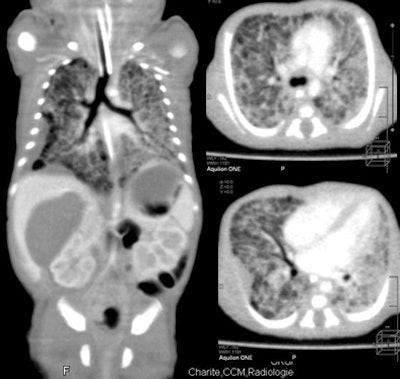 2010 02 24 17 08 01 940 Rogalla pleural thickening