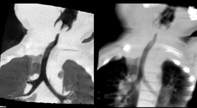 2010 02 24 17 08 09 40 Rogalla hemangioma top