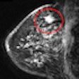 2010 03 16 13 58 57 537 2010 03 17 Breast Mri Thumb