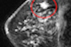 2010 03 16 13 58 57 537 2010 03 17 Breast Mri Thumb