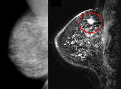 2010 03 16 13 59 01 658 2010 03 17 Breast Mri