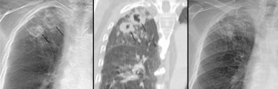 2010 03 18 15 22 17 179 2010 03 19 Tb Comp