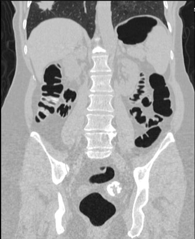 2010 03 23 12 44 14 180 Pickhardt lungcancer