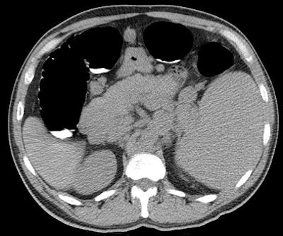 2010 03 23 12 44 22 46 Pickhardt lymphoma