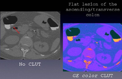 2010 04 01 13 40 51 584 Faggione flatlesion