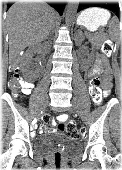 2010 05 17 13 59 05 126 Nelson fbp abdomen top