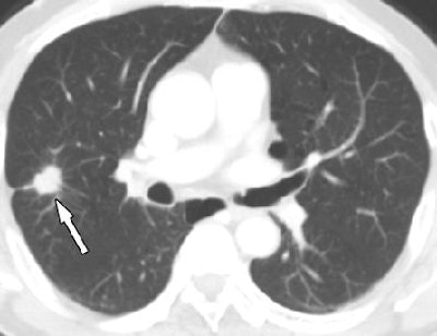 2010 05 25 14 10 50 207 Kim lungcancer top