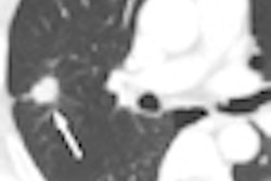 2010 05 25 14 10 50 834 Kim lungcancer thumb 05 10 70