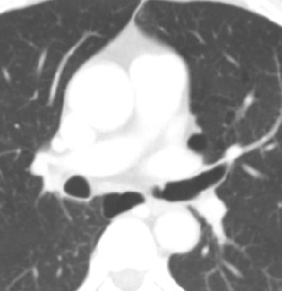 2010 05 25 14 10 51 134 Kim lungcancer bottom