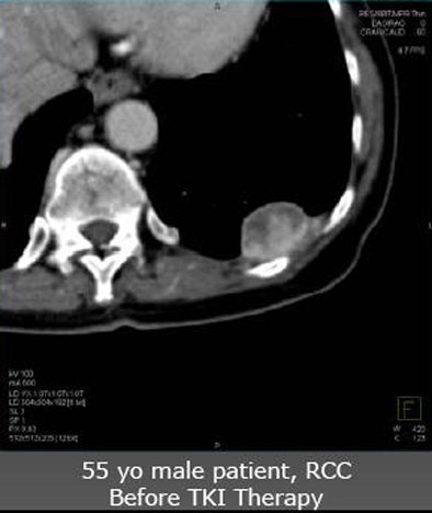 2010 06 11 14 41 17 480 Nicolau 55patient top V2