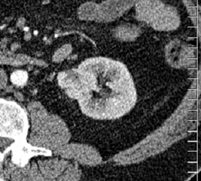 2010 06 14 12 58 00 595 Oconnor bottom renal