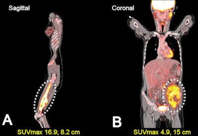 2010 06 22 10 57 02 457 Walter Sarcoma Slide11 450