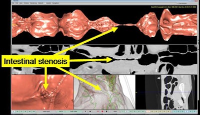 2010 06 28 11 05 43 703 Oda stenosis