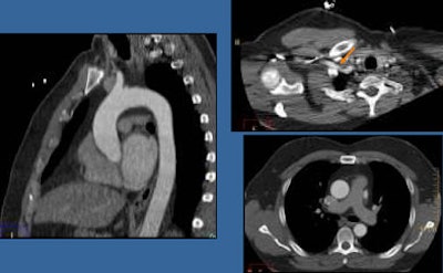 2010 07 06 11 40 52 856 Halliburton aneurysm
