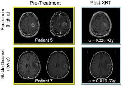 2010 07 09 14 19 54 829 Glioma Medphysics Radtherapy 450