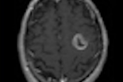 2010 07 09 14 25 16 843 Glioma Medphysics Radtherapy 70v2