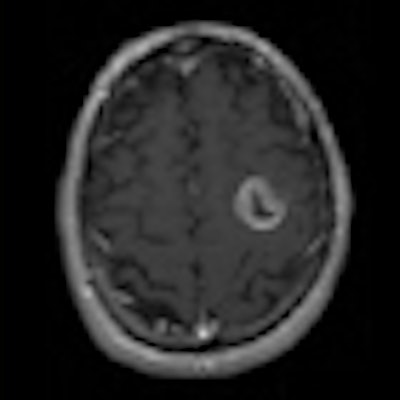 2010 07 09 14 25 16 843 Glioma Medphysics Radtherapy 70v2