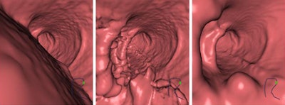 3D endoscopic views of a polyp in a pig colon after (left) no electronic cleansing, i.e., original CTC data; (middle) structure-analysis electronic cleansing applied to single-energy CTC data; and (right) dual-energy electronic cleansing.