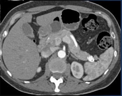 2010 07 21 12 06 40 79 Fishman splenic artery aneurism not islet