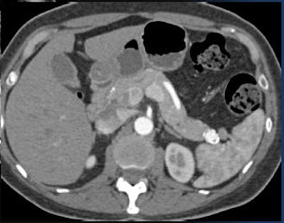 2010 07 21 12 06 40 79 Fishman splenic artery aneurism not islet
