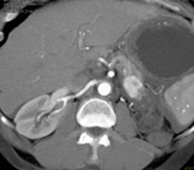 2010 07 21 12 06 42 892 Fishman rcc metastasis