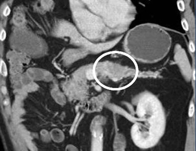 2010 07 21 12 06 44 693 Fishman dilated pancreatic duct