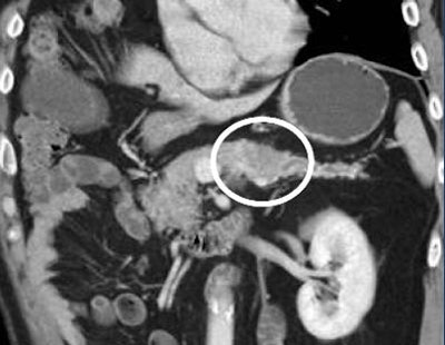 2010 07 21 12 06 44 693 Fishman dilated pancreatic duct