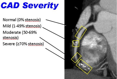 2010 07 26 10 57 21 859 Min stenosis