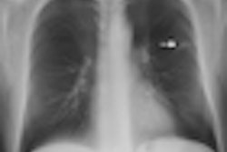 2010 07 27 11 22 14 246 Lung Tomosynthesis Quaia 07 2010 Thumb