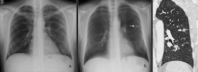 2010 07 27 11 22 15 529 Lung Tomosynthesis Quaia 07 2010 450