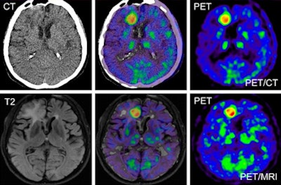 Simultaneous PET/MRI creates diagnostic-quality images | AuntMinnie