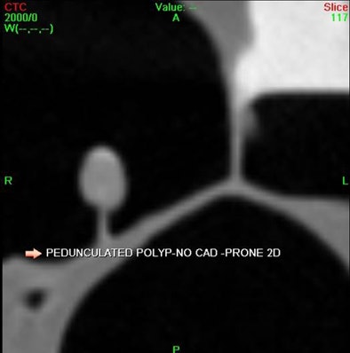 2010 08 09 13 48 42 401 Dachman top i Cad Sample Polyp 2 D Axial Ca Doff