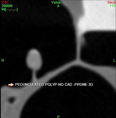 2010 08 09 13 48 42 401 Dachman top i Cad Sample Polyp 2 D Axial Ca Doff