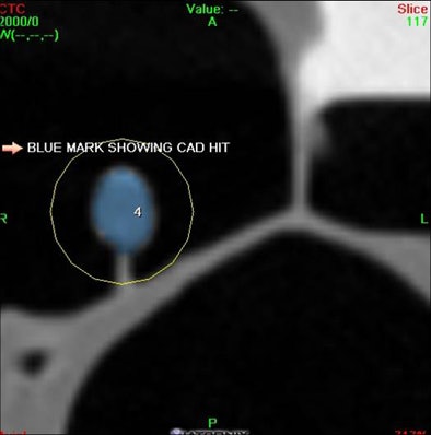 2010 08 09 13 48 44 910 Dachman middle i Cad Sample Polyp 2 D Axial Cad