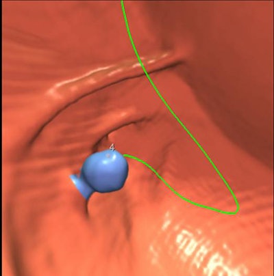 2010 08 09 13 48 46 796 Dachman bottom i Cad Sample Polyp W Cad
