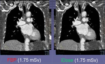 In addition to reducing dose, iterative reconstruction can address common problems such as artifacts in the shoulder region in coronal image above.