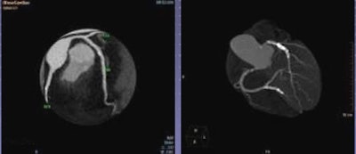 Prospectively acquired axial coronary CT angiography (CTA) image in ultralow-dose step-and-shoot acquisition (0.25 mSv) is diagnostic with the use of advanced iterative reconstruction.